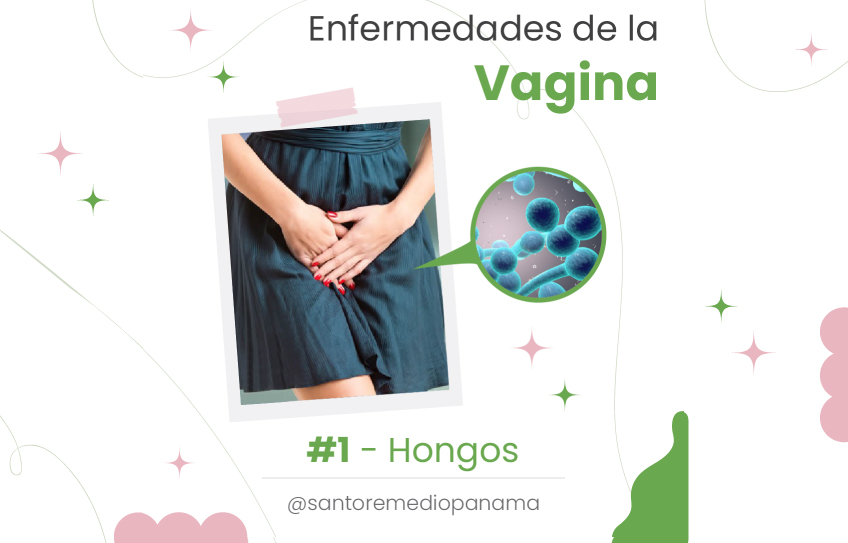 Enfermedades de la vagina: #1. Hongos